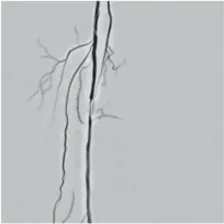 Lower-limb angiogram, segment 1