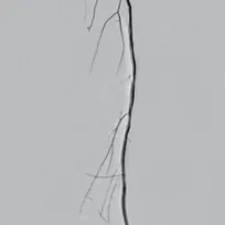 Lower-limb angiogram, segment 2
