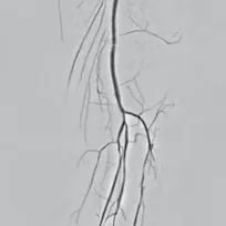 Lower-limb angiogram, segment 3