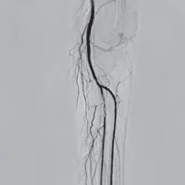 Lower-limb angiogram, segment 4