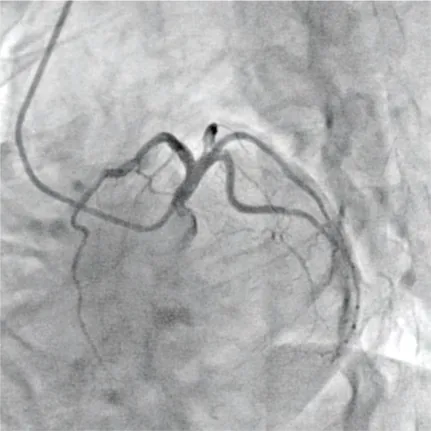 Coronary angiogram