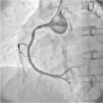 Coronary angiogram