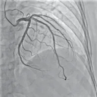 Coronary angiogram