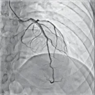 Coronary angiogram