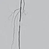 Peripheral angiogram