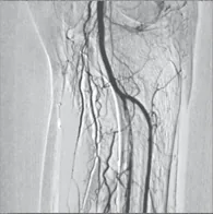 Lower-limb angiogram