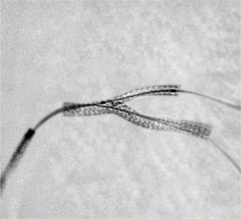 Stent view