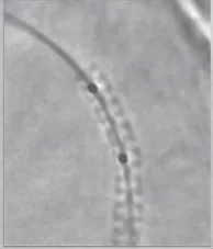 Stent view