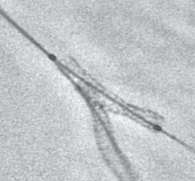 Stent view