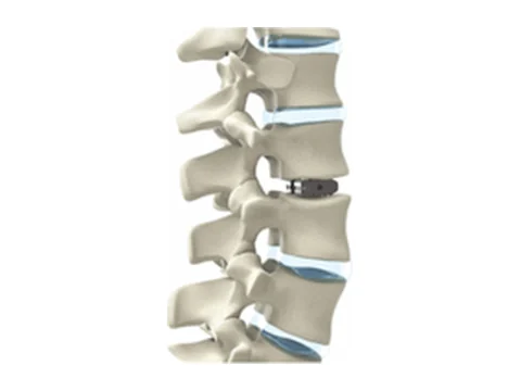 Spine systems — pack